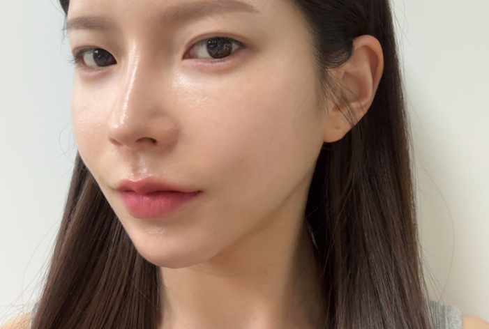 팔자필러 시술 후